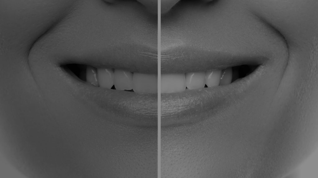 BLANQUEAMIENTO en Barcelona - Clínica Dental CDZ