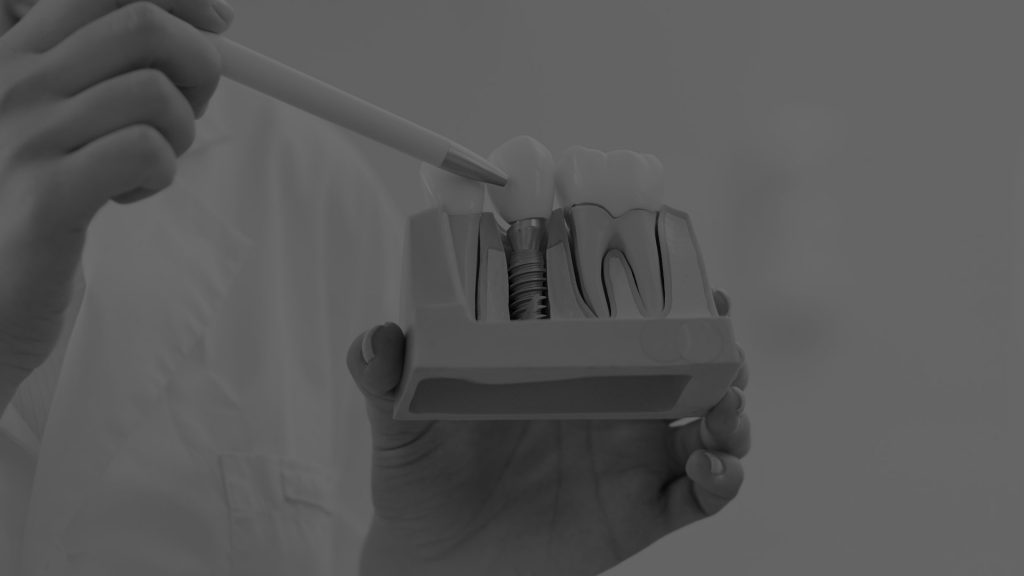 IMPLANTES DENTALES en Barcelona - Clínica Dental CDZ