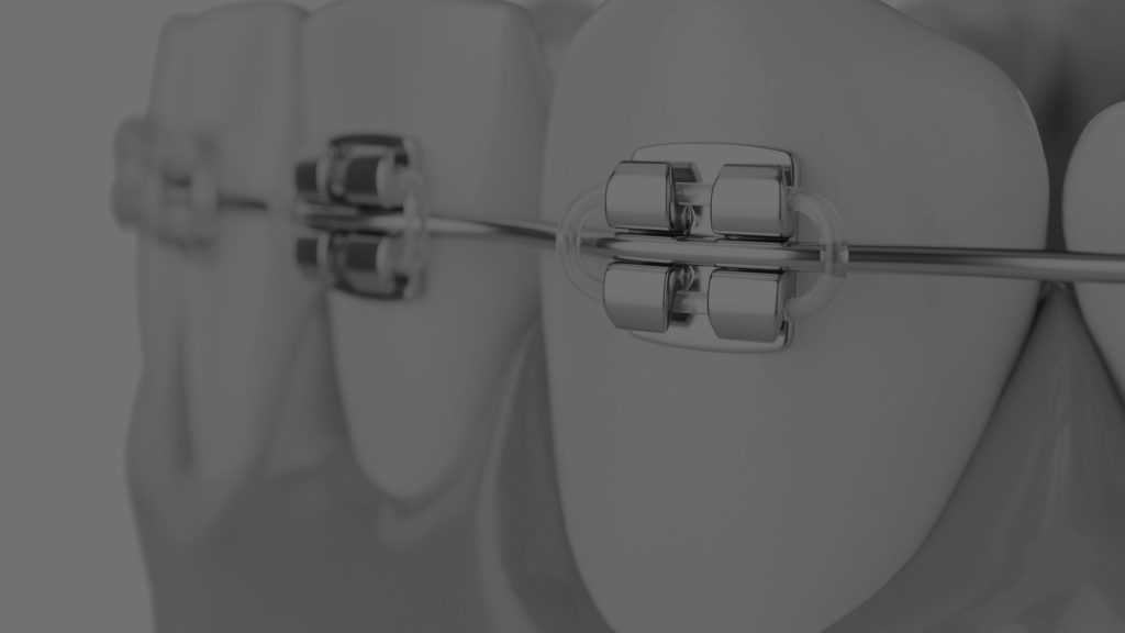 ORTODONCIA en Barcelona - Clínica Dental CDZ